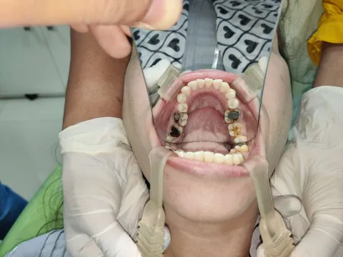 Orthomania orthodontic training for general dentists, Chembur Mumbai, photo 78